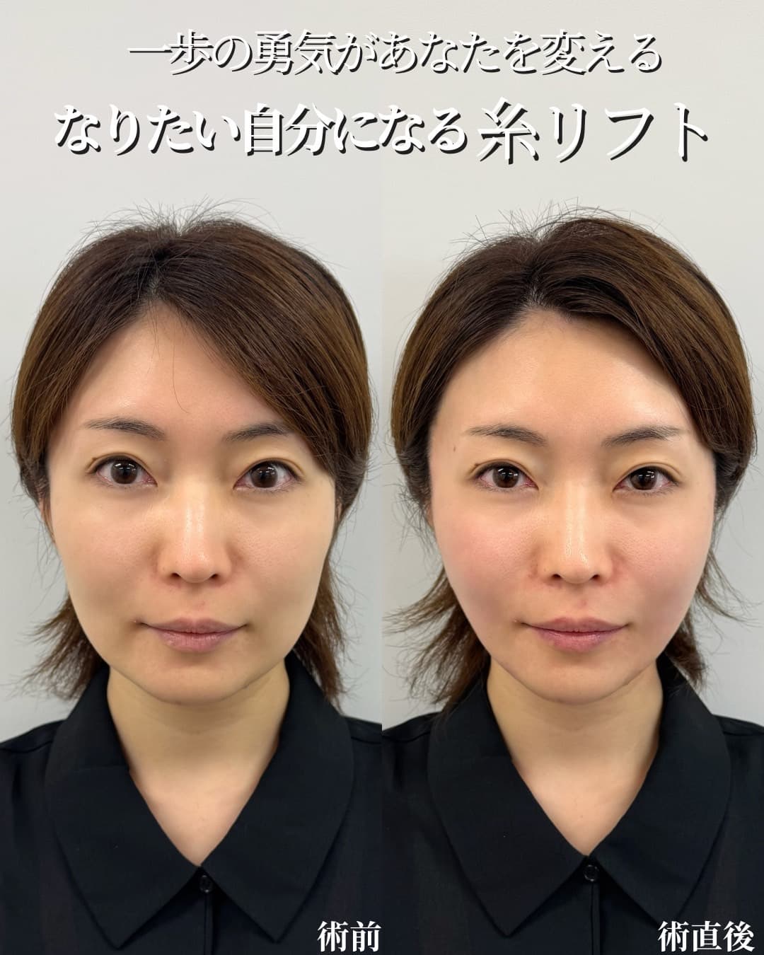 糸リフト