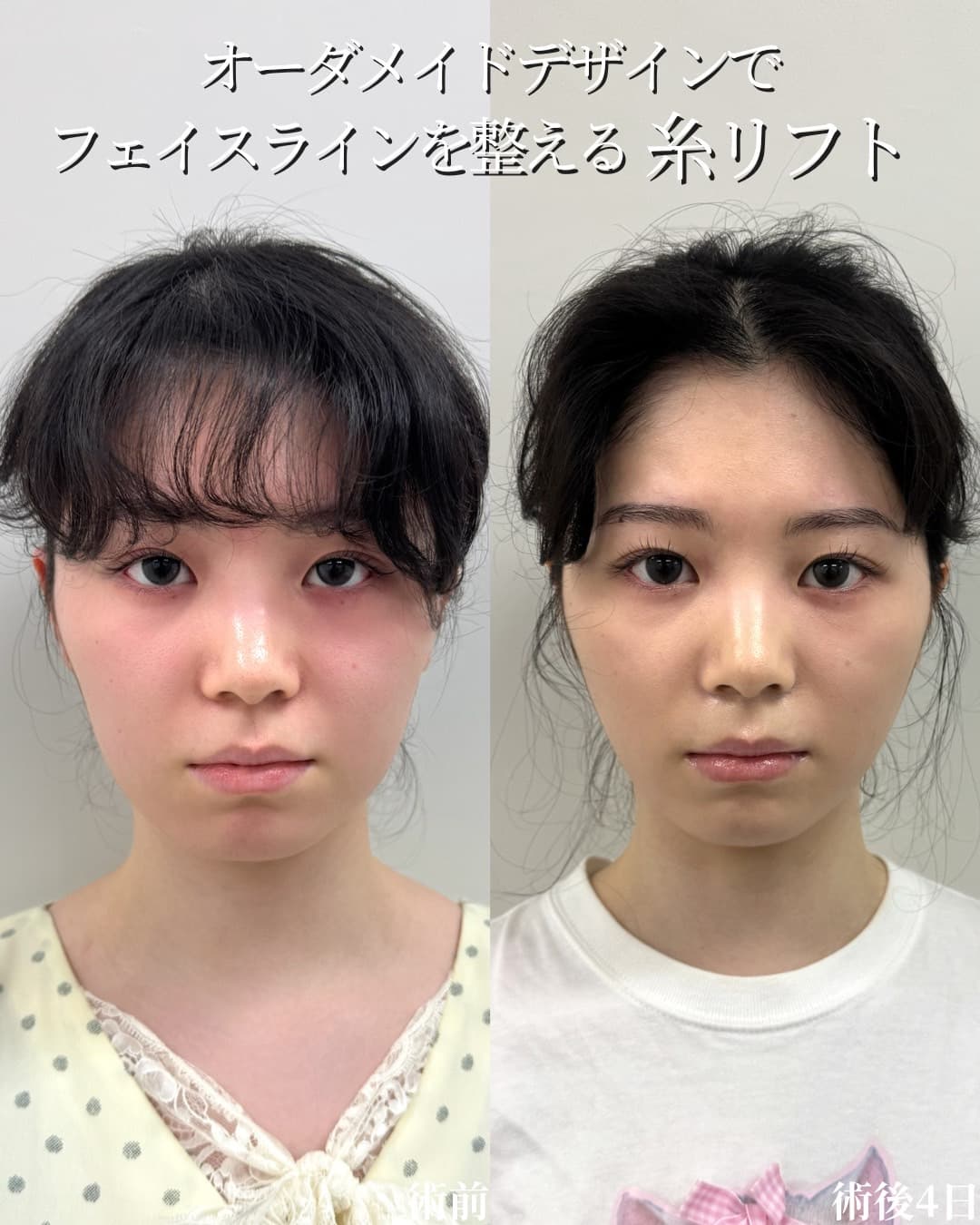 糸リフト