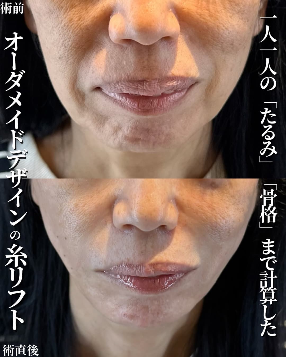 糸リフト