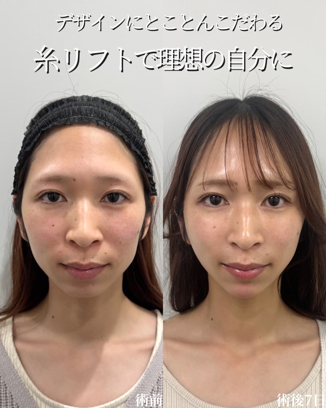 糸リフト+ヒアルロン酸
