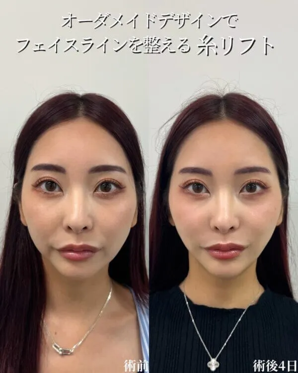 糸リフトの症例