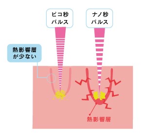 ナノ秒パルスでレーザーを照射
