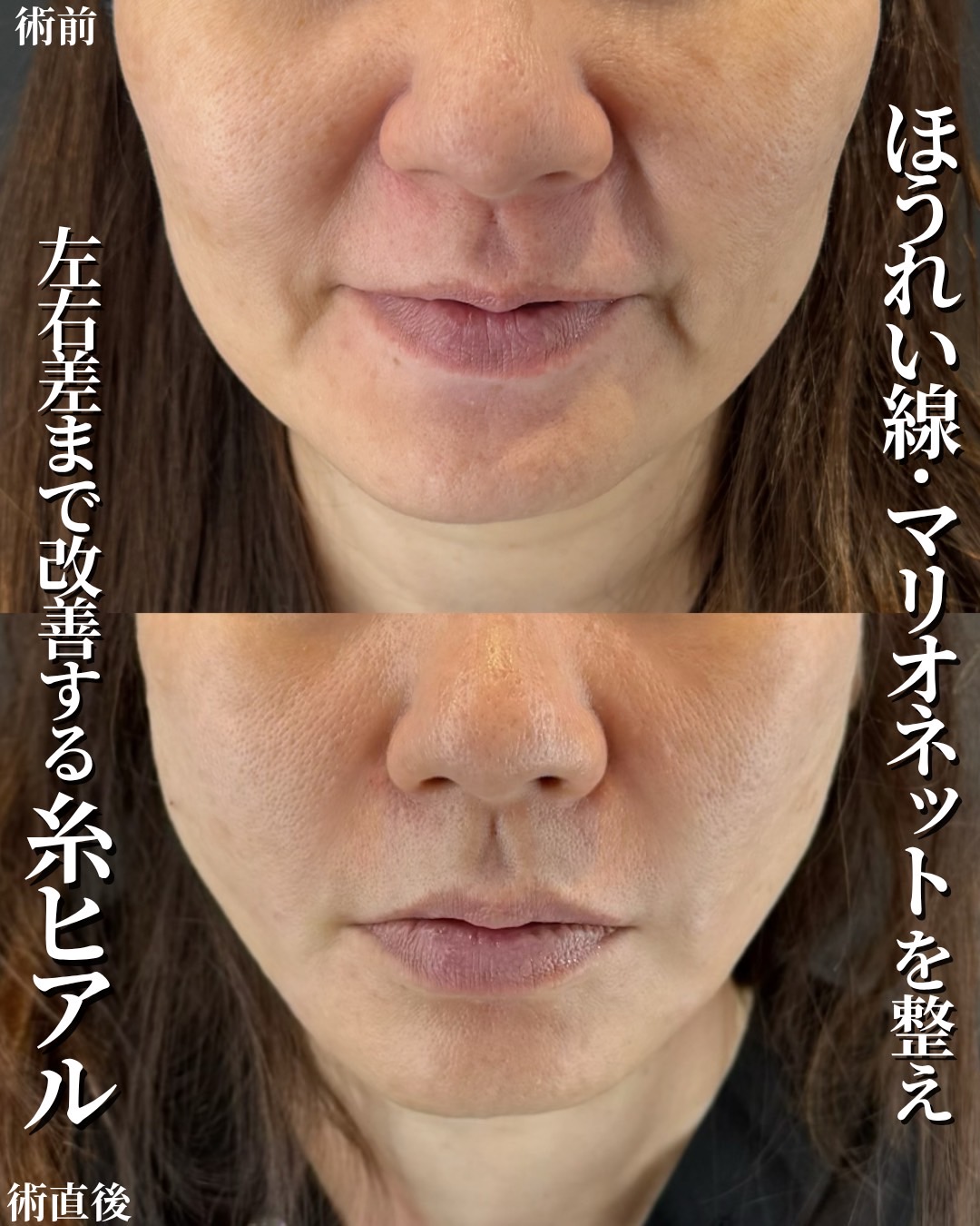 糸リフト+ヒアルロン酸
