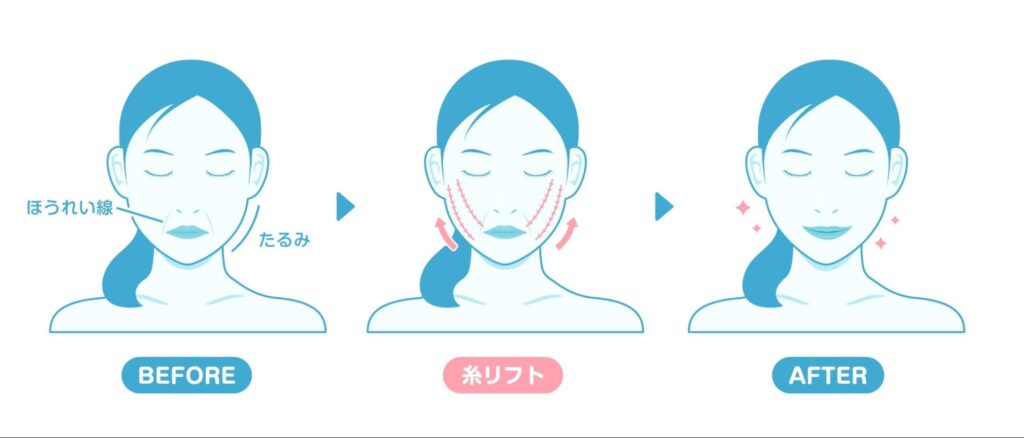 糸リフト 若いうち